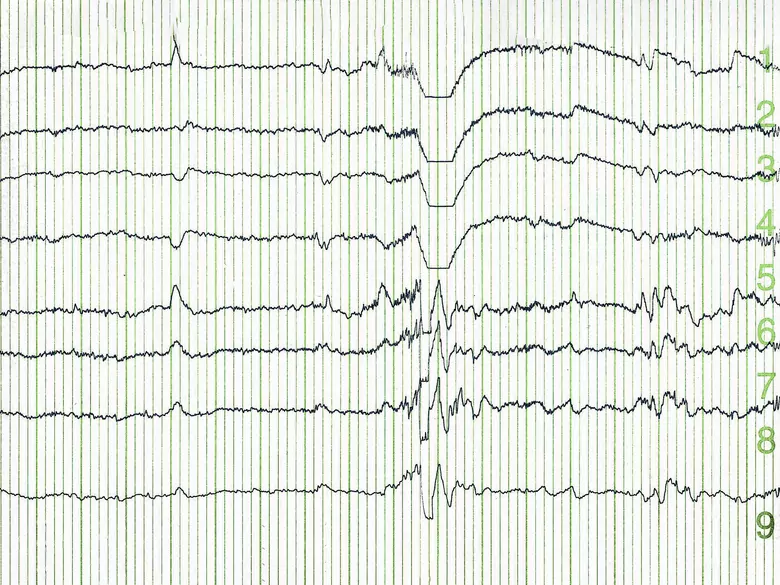 Charakterystyka metod neurotechnologicznych w praktyce medycznej